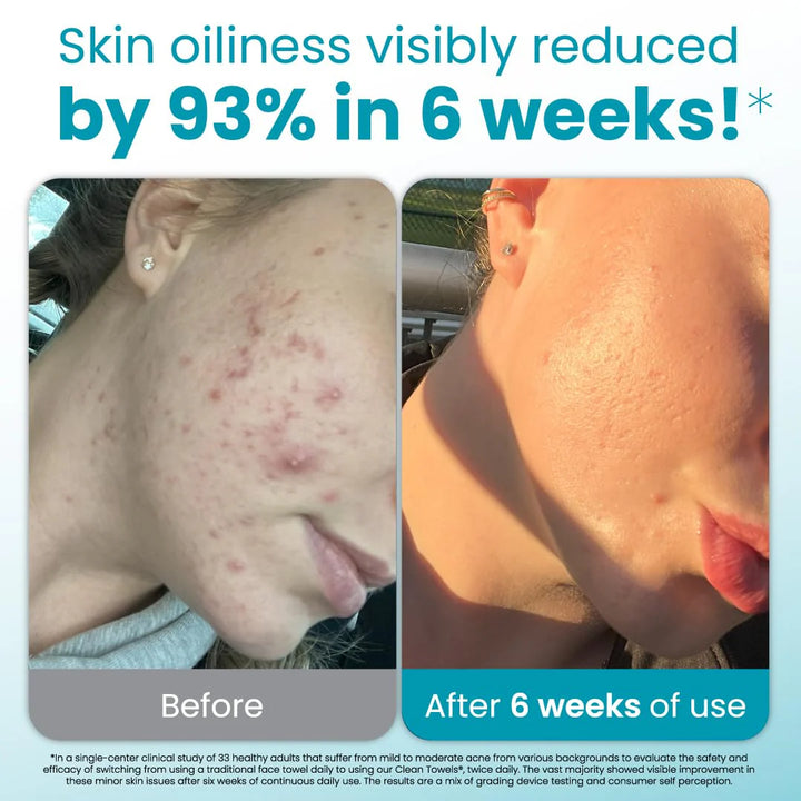 Clean Towels® Oily Skin