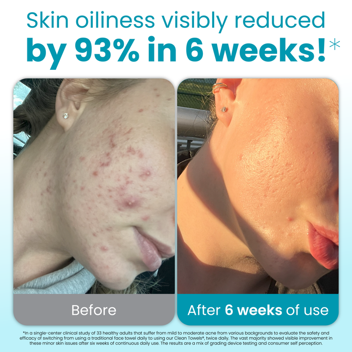 Clean Towels® Oily Skin
